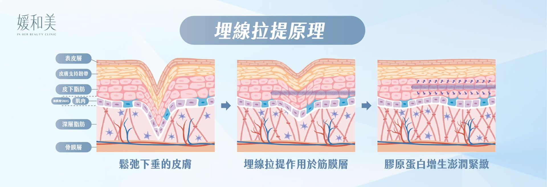 埋線拉提作用層次示意圖