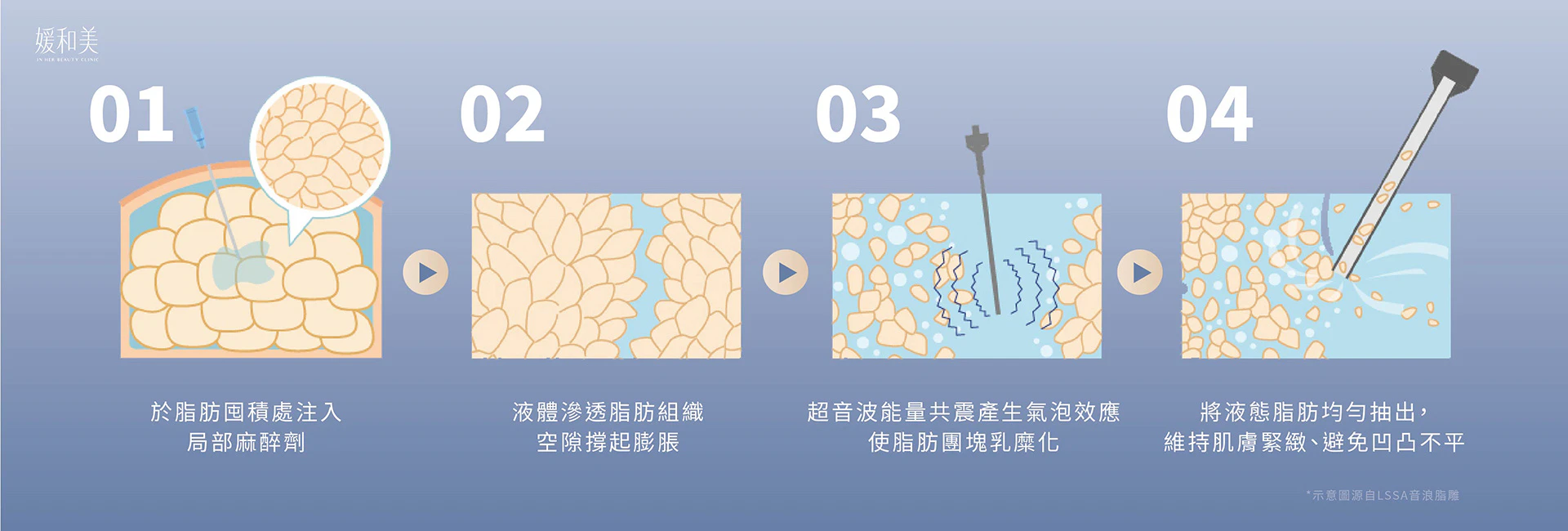 LSSA 音浪脂雕超音波輔助脂肪處理步驟示意圖